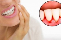 Chảy máu chân răng cảnh báo bệnh gì?