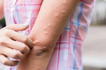 Nổi mề đay mùa Hè, phải làm sao?