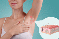 Sống chung với viêm tuyến mồ hôi mủ trong mùa Hè