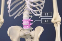 Dấu hiệu nhận biết thoát vị đĩa đệm L3 L4