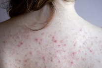 Bị mụn lưng phải làm sao?