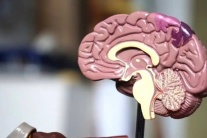 Tai biến mạch máu não ảnh hưởng đến não phải và não trái ra sao?