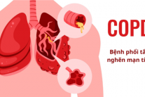Cách nhận biết sớm bệnh phổi tắc nghẽn mạn tính (COPD)