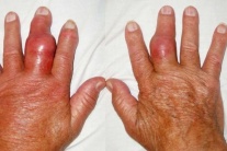 Hạt tophi xuất hiện ở người bệnh gout: Cảnh báo không nên chủ quan