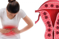 Một số bệnh phụ khoa có thể làm tăng nguy cơ bệnh tim và đột quỵ?