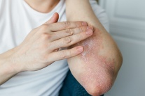 Nguyên nhân nào khiến vảy nến lan ra toàn thân?
