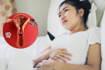 Đột phá điều trị lạc nội mạc tử cung bằng sóng cao tần