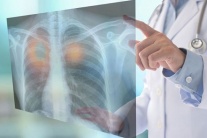 Dấu hiệu nhận biết u phổi lành tính và ác tính