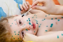 Những sai lầm thường gặp khi chữa thủy đậu cho trẻ?