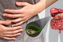 Sỏi mật gây đau bụng, đầy trướng và chậm tiêu xử trí thế nào?