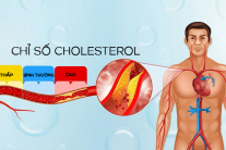 Tăng cholesterol kéo dài: Mối nguy âm thầm thúc đẩy xơ vữa động mạch