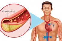 Bảo vệ trái tim trước mối nguy do tăng cholesterol