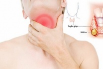 Có những loại bướu tuyến giáp nào?