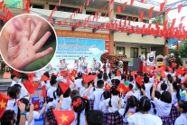 Bộ Y tế cảnh báo gia tăng bệnh tay chân miệng trong mùa tựu trường