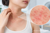 Phát ban do nhiệt: Nhận biết và xử lý thế nào?