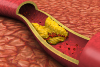 Cholesterol cao và xơ vữa động mạch: Mối liên hệ nhiều người còn chủ quan
