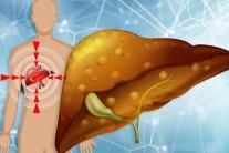 Có thể đảo ngược gan nhiễm mỡ mà không dùng thuốc?