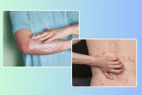 Mẹo chăm sóc da cho người bệnh vảy nến thể mảng