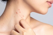 Hướng đi mới giúp kiểm soát bệnh lupus ban đỏ từ thảo dược tự nhiên