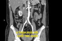 Tình cờ phát hiện u thận kèm huyết khối tĩnh mạch chủ