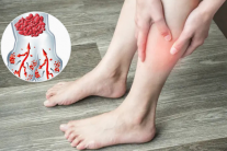 4 dấu hiệu cảnh báo cục máu đông phụ nữ không nên chủ quan