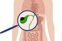 Đa polyp túi mật 9x8mm nên xử trí thế nào?