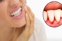 Bị viêm quanh răng có nguy hiểm không?