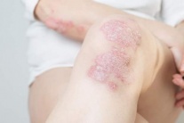 Chủ động kiểm soát vảy nến từ sớm để không lo bệnh bùng phát khi trời lạnh
