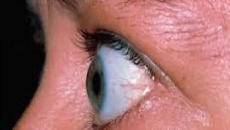 Chữa lồi mắt do bệnh cường tuyến giáp Basedow