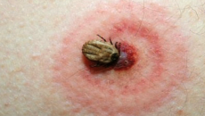 27 nghìn người mắc bệnh Lyme vì bọ ve 