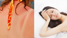 5 dấu hiệu cho thấy bạn đang bị 'ngộ độc nắng'