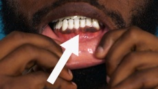 Video: Vì sao nướu răng của bạn bị thâm đen, tối màu?