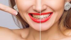 Thói quen chăm sóc răng miệng có thể khiến răng ố vàng