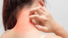 Viêm da do dị ứng phấn hoa có thể bôi Subạc?