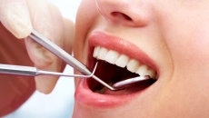 Có nên nhổ răng khôn mọc lệch, nhổ răng khôn có biến chứng gì?