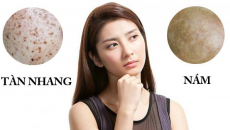 Nám và tàn nhang khác nhau thế nào?