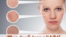 Những điều cần biết về mụn nội tiết