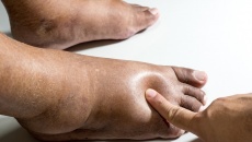 6 nguyên nhân gây sưng bàn chân, mắt cá chân