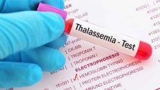 Vì sao các cặp vợ chồng nên sàng lọc thalassemia trước khi kết hôn? 