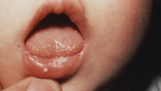 Trẻ bị đốm trắng trong miệng và lưỡi do đâu? 
