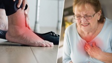 Suy tim gây mệt mỏi, phù chân: Làm sao để cải thiện triệu chứng?