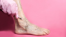 6 lầm tưởng về suy giãn tĩnh mạch bạn cần quên ngay lập tức