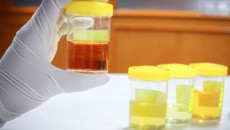Nước tiểu màu vàng cam có thể cảnh báo ung thư tuyến tụy