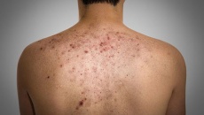 Mụn lưng – 4 nguyên nhân và cách khắc phục
