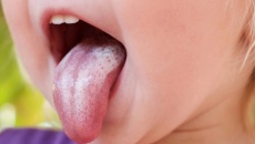 Biện pháp khắc phục nấm miệng (tưa lưỡi) ở trẻ nhỏ