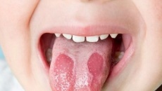 Dấu hiệu bất thường ở lưỡi cảnh báo bệnh mạn tính nguy hiểm