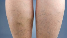 3 bài tập cải thiện chứng suy giãn tĩnh mạch