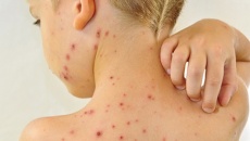 Làm thế nào để giảm ngứa khi bị thủy đậu?
