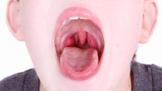 Trẻ viêm họng nên ăn và kiêng ăn uống gì?