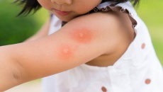 Một vài lưu ý khi chăm trẻ bị sốt xuất huyết tại nhà 